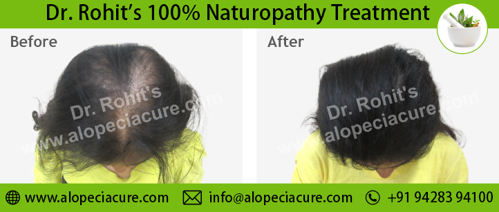 hair loss treatment